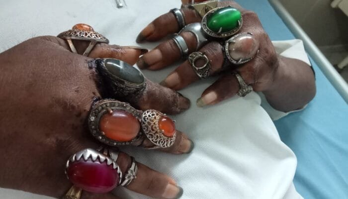 Pemadam Kebakaran Bengkulu Evakuasi 16 Cincin dari Jari Pasien RSJ