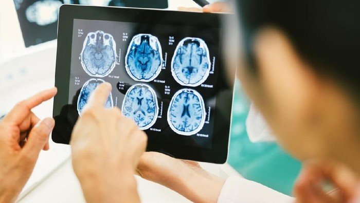 Terobosan Ilmuwan Temukan Pil Potensial Pembunuh Kanker Otak Glioblastoma